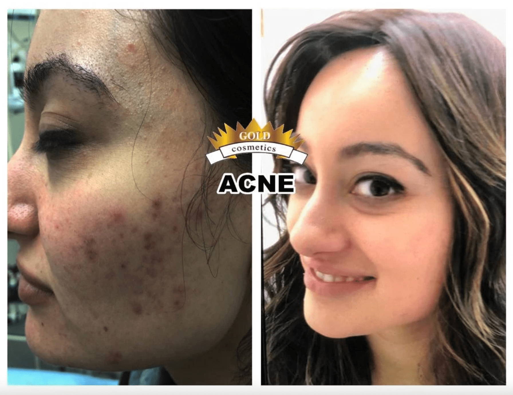 Gold Cosmetics The Ultimate Acne Kit For Glowing Skin Gold